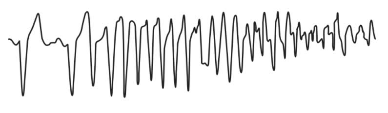 心電図モニターで不整脈（arrhythmia）の変化がみられた。このときの心電図を別に示す。 初期対応で適切なのはどれか。