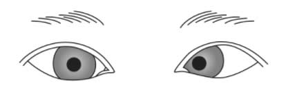 次の文を読み、以下の問いに答えよ。 Aちゃん（3歳、男児）は、斜視（strabismus）の手術のために母親とともに歩いて入院した。入院期間は3日の予定である。3週前に外来で医師と看護師がAちゃんに手術と入院とについて説明した。入院時、Aちゃんはやや緊張した表情をしているが「眼の手術をしに来たの。病院に2つ泊まるんだよ」と看護師に話した。 Aちゃんの眼の状態を図に示す。 Aちゃんの斜視（strabismus）はどれか。